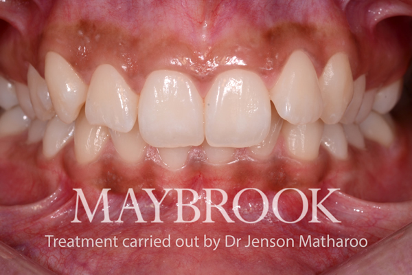 Before Fixed Metal Braces in Central London