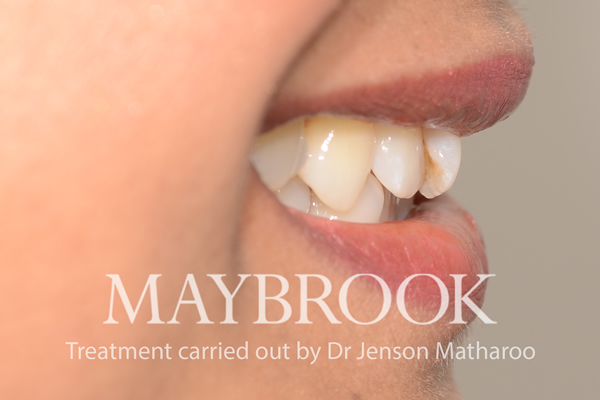 Before Fixed Metal Braces in Central London