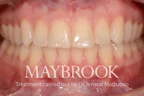 After Fixed Metal Braces in Soho